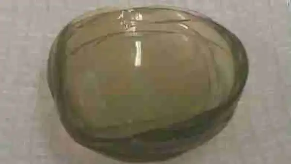 Doctors Remove 27 Contact Lenses From A 67-Year-Old Woman
